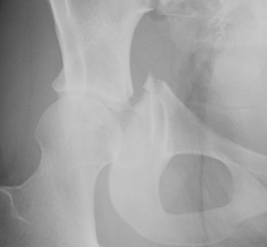 Acetabular Fracture Pre Steinman Pin